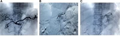 Gastric transcatheter chemoembolization can resolve advanced gastric cancer presenting with obstruction